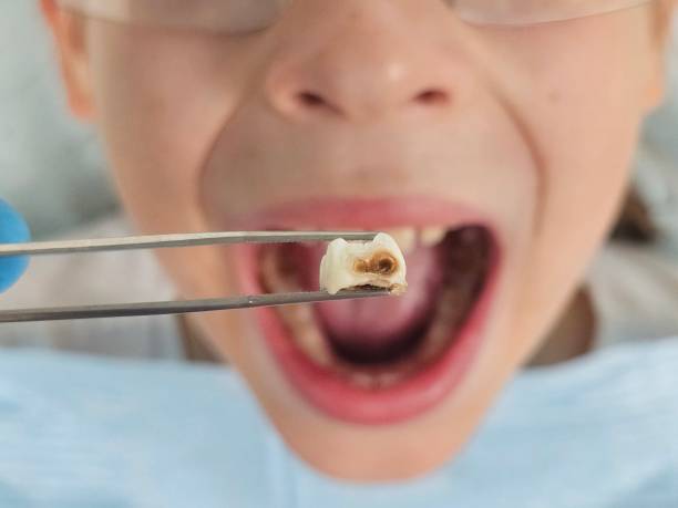 Best Emergency Care for Gum Disease in Abilene, KS